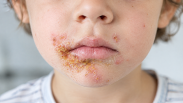impetigine nei bambini