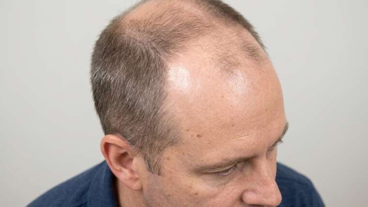 alopecia androgenetica