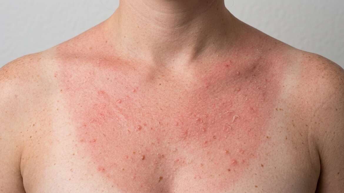 dermatite solare