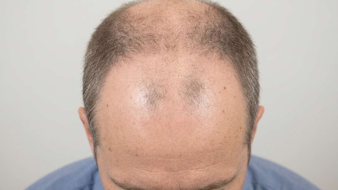 perdita dei capelli e calvizie maschile