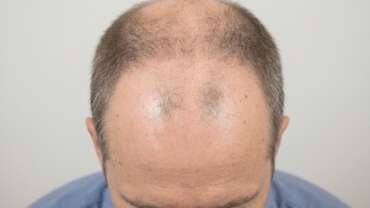 perdita dei capelli e calvizie maschile