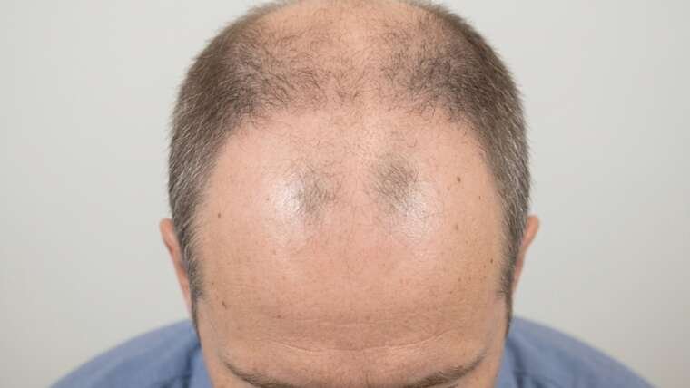 perdita dei capelli e calvizie maschile