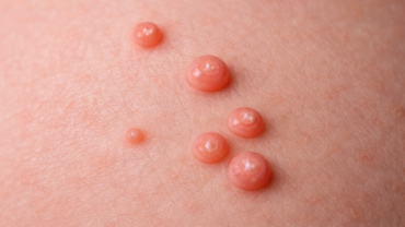 Lesione da mollusco contagioso