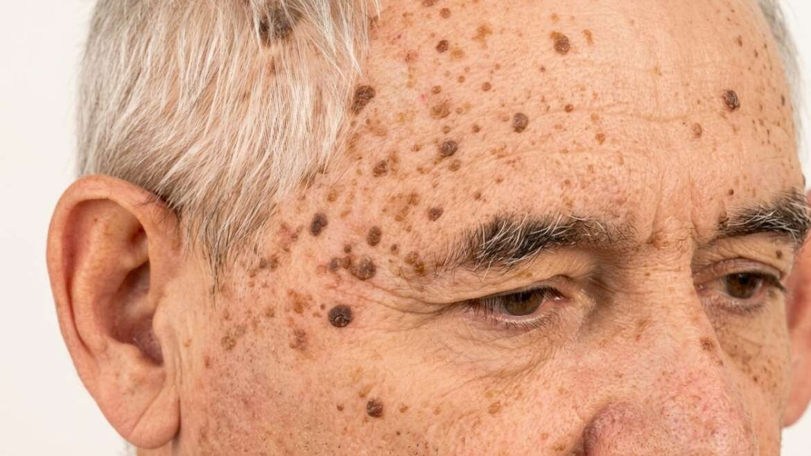cheratosi attiniche