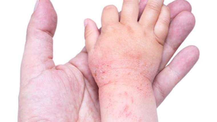 Dermatite atopica nei bambini: cause, sintomi e cure