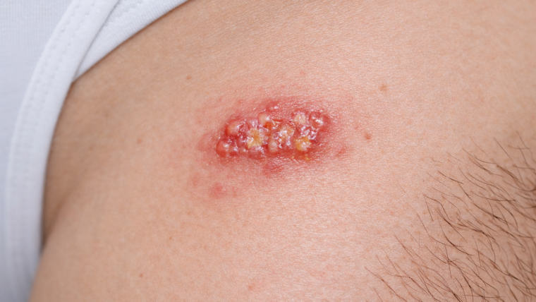 Herpes genitale: come e perchè compare - consigli del dermatologo