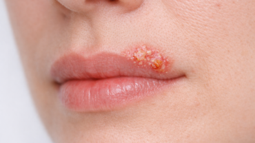 Herpes labiale: cos'è e come gestirlo - consigli del dermatologo