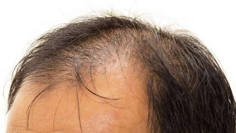 Perdita di capelli nell'uomo: tutto sulla calvizie maschile