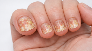 Psoriasi delle unghie: cos'è e come curarla col dermatologo