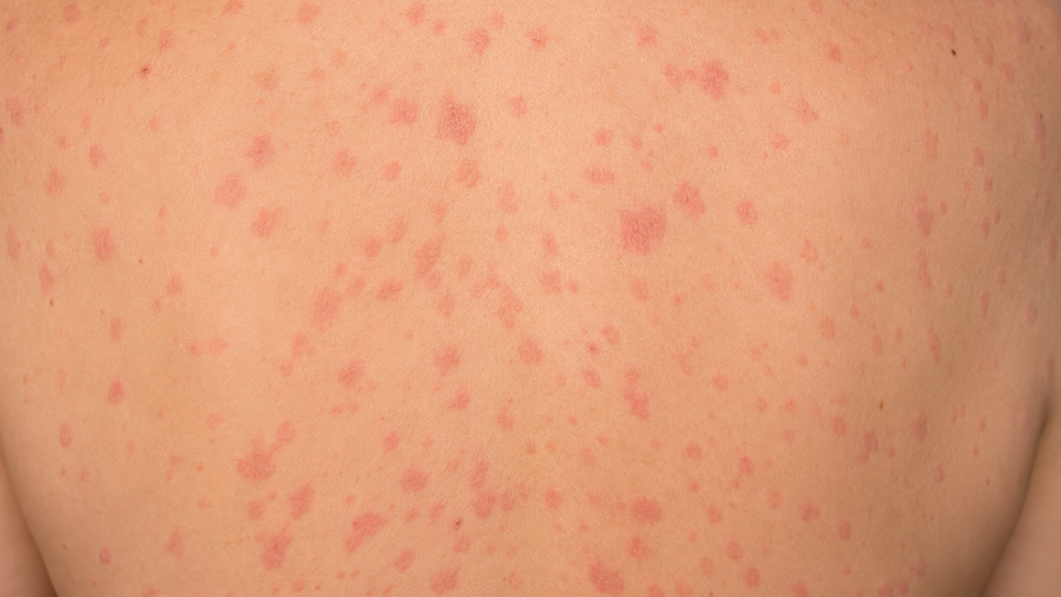 Psoriasi guttata: cos'è e come sconfiggerla con il dermatologo a Roma
