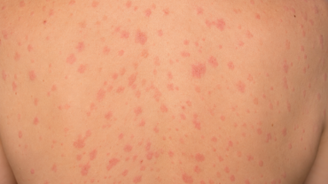 Psoriasi guttata: cos'è e come sconfiggerla con il dermatologo a Roma