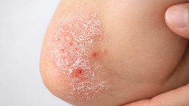 psoriasi