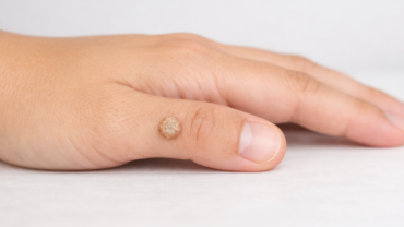 verruche - dermatologo a Roma