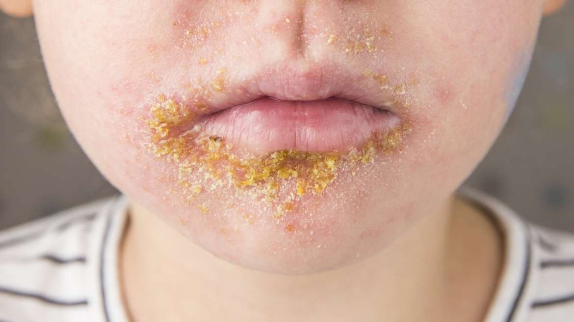 Immagine di un bambino con lesioni cutanee causate da impetigine, mostrando vescicole e croste color miele sulla pelle.